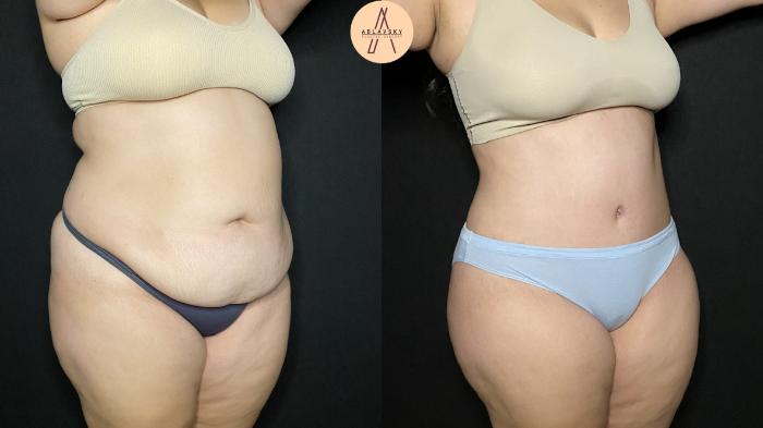 Before & After Liposuction Case 161 Right Oblique View in San Antonio, Texas