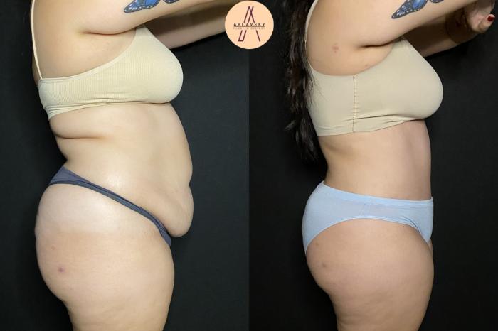 Before & After Liposuction Case 161 Right Side View in San Antonio, Texas