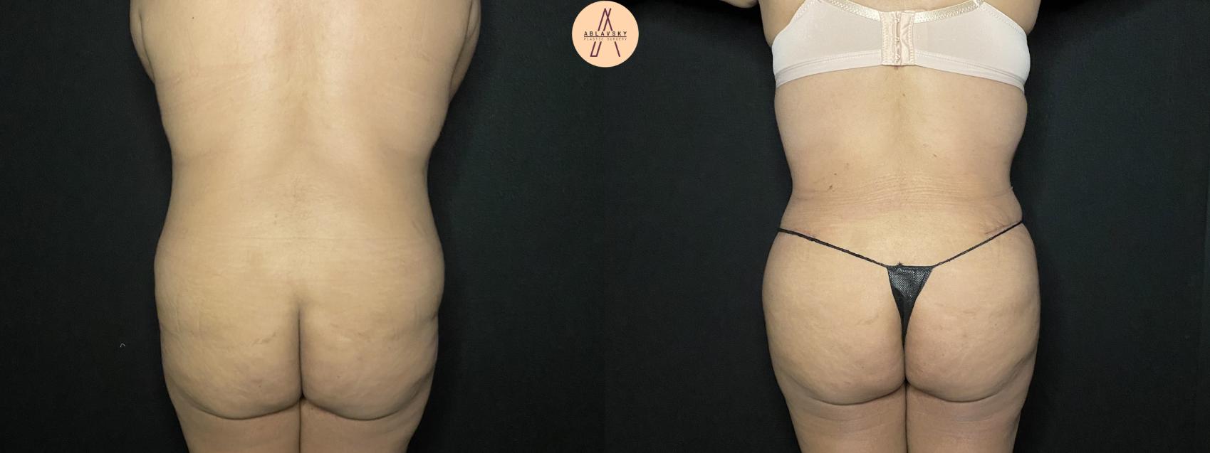 Before & After Liposuction Case 164 Back View in San Antonio, Texas