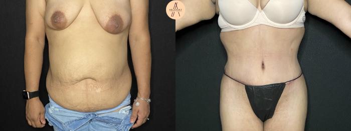 Before & After Liposuction Case 164 Front View in San Antonio, Texas