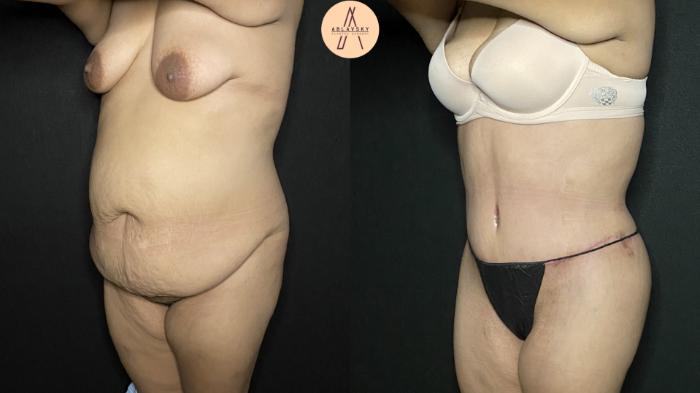 Before & After Tummy Tuck Case 164 Left Oblique View in San Antonio, Texas