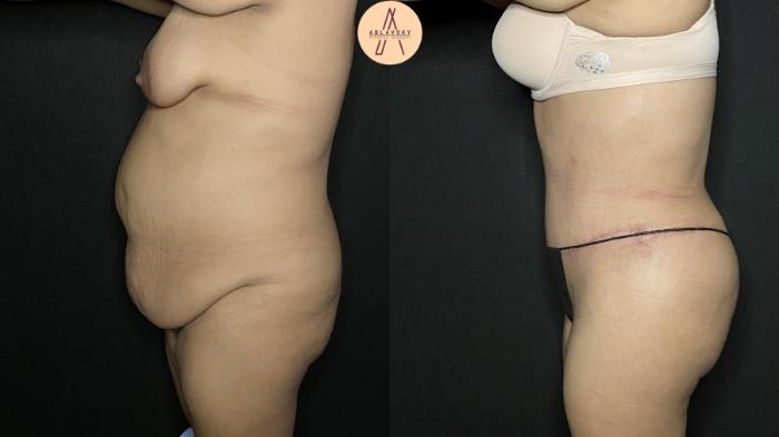 Before & After Liposuction Case 164 Left Side View in San Antonio, Texas