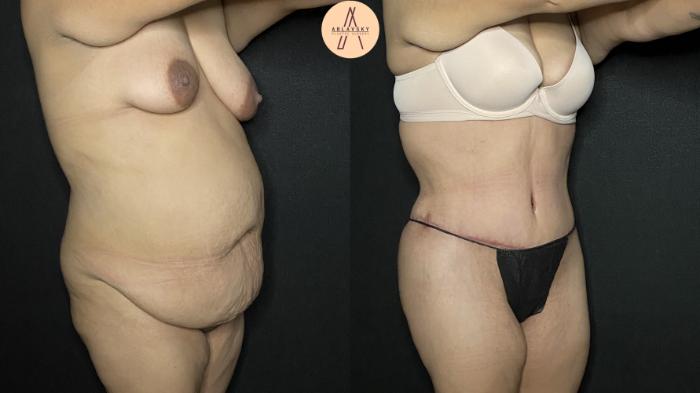 Before & After Tummy Tuck Case 164 Right Oblique View in San Antonio, Texas