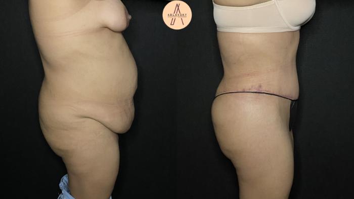 Before & After Tummy Tuck Case 164 Right Side View in San Antonio, Texas