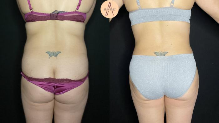 Before & After Tummy Tuck Case 176 Back View in San Antonio, Texas