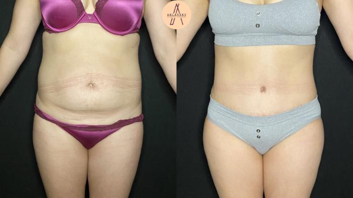 Before & After Liposuction Case 176 Front View in San Antonio, Texas