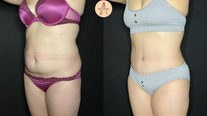 Before & After Liposuction Case 176 Left Oblique View in San Antonio, Texas