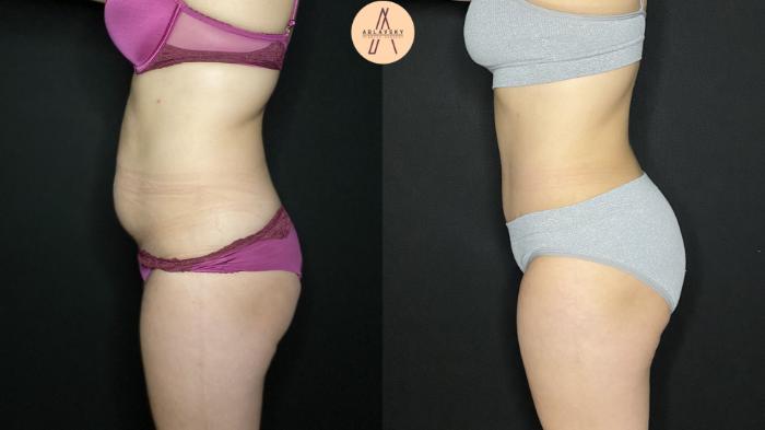 Before & After Tummy Tuck Case 176 Left Side View in San Antonio, Texas
