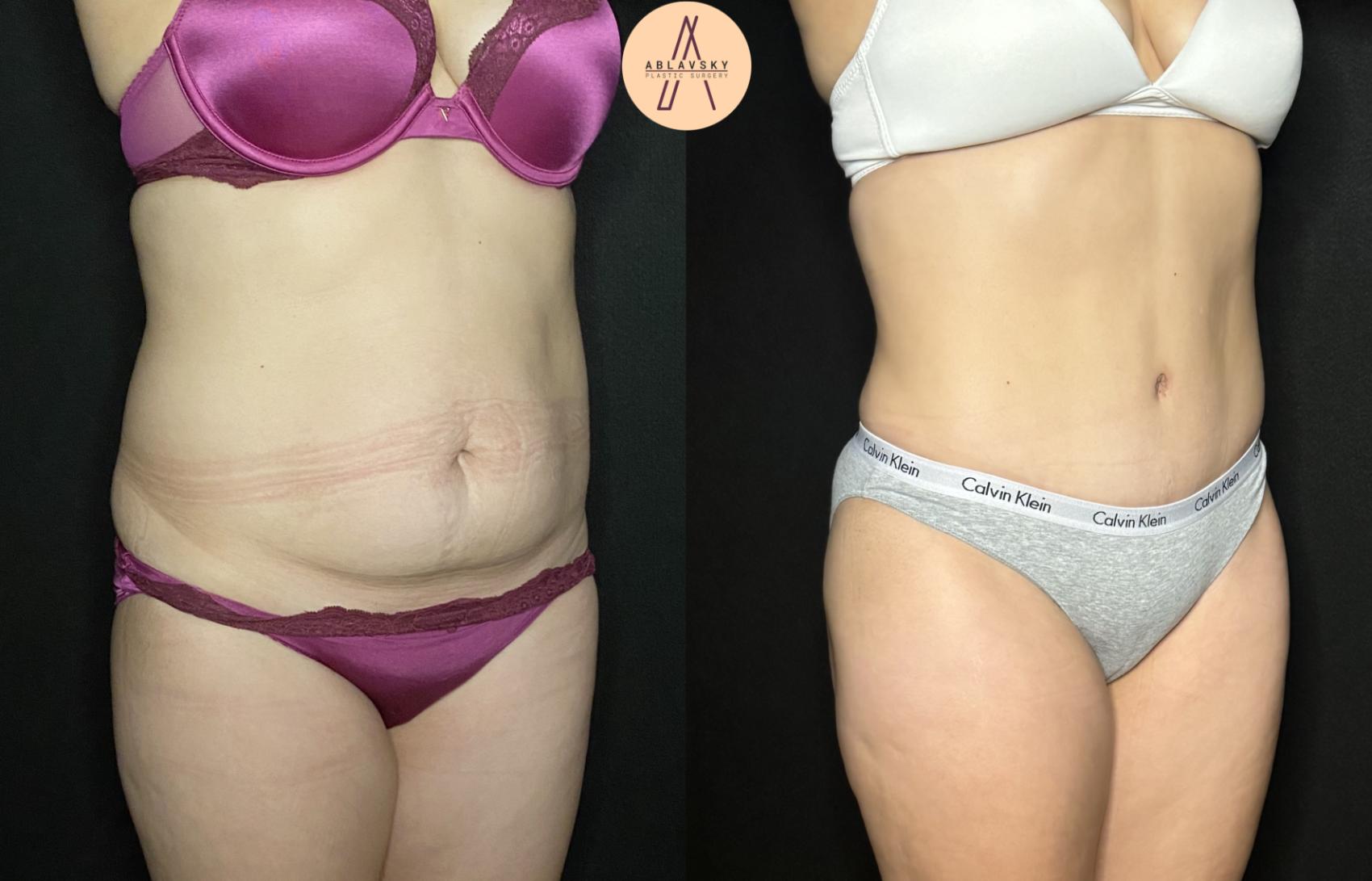 Before & After Liposuction Case 176 Right Oblique View in San Antonio, Texas