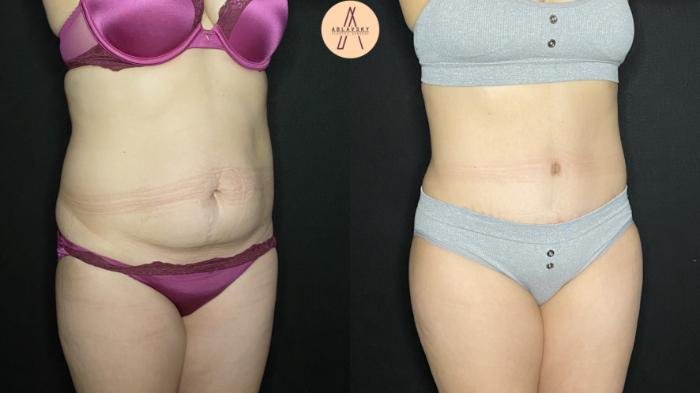 Before & After Liposuction Case 176 Right Oblique View in San Antonio, Texas