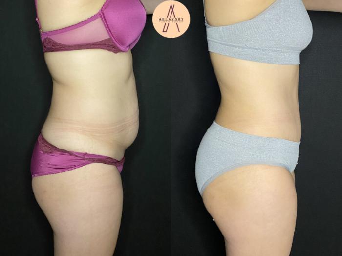 Before & After Liposuction Case 176 Right Side View in San Antonio, Texas