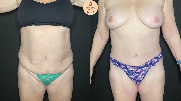 Before & After Tummy Tuck Case 179 Front View in San Antonio, Texas