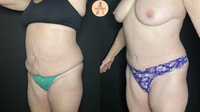 Before & After Tummy Tuck Case 179 Left Oblique View in San Antonio, Texas
