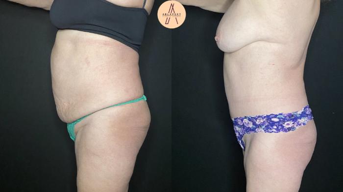 Before & After Tummy Tuck Case 179 Left Side View in San Antonio, Texas