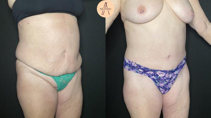 Before & After Tummy Tuck Case 179 Right Oblique View in San Antonio, Texas