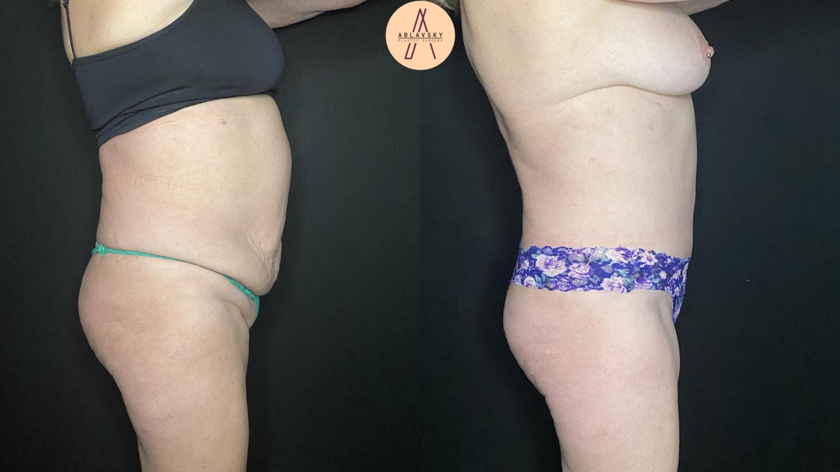 Before & After Tummy Tuck Case 179 Right Side View in San Antonio, Texas
