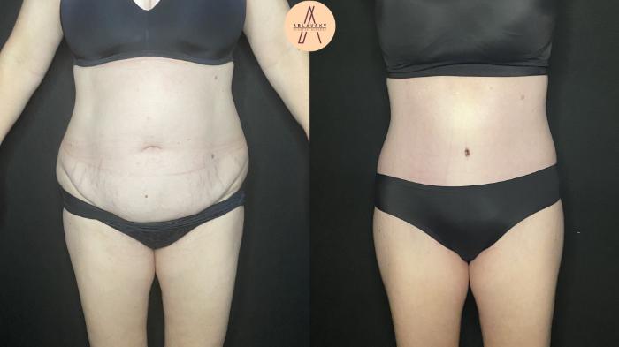Before & After Tummy Tuck Case 184 Front View in San Antonio, Texas