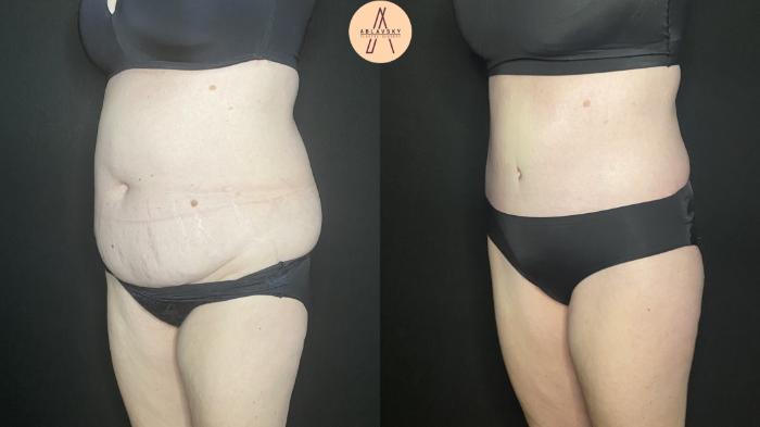 Before & After Tummy Tuck Case 184 Left Oblique View in San Antonio, Texas