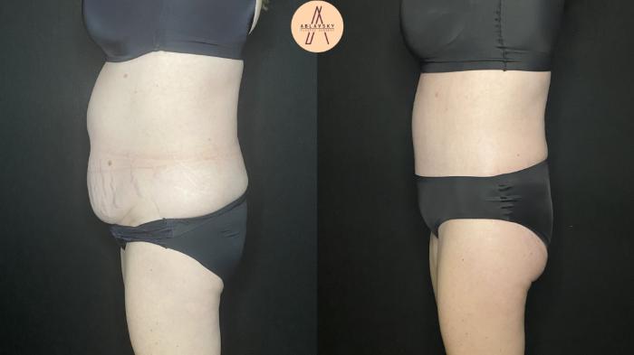 Before & After Tummy Tuck Case 184 Left Side View in San Antonio, Texas