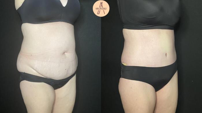 Before & After Tummy Tuck Case 184 Right Oblique View in San Antonio, Texas