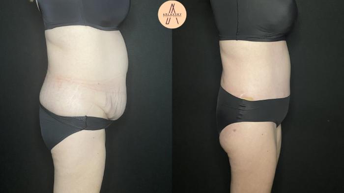 Before & After Tummy Tuck Case 184 Right Side View in San Antonio, Texas