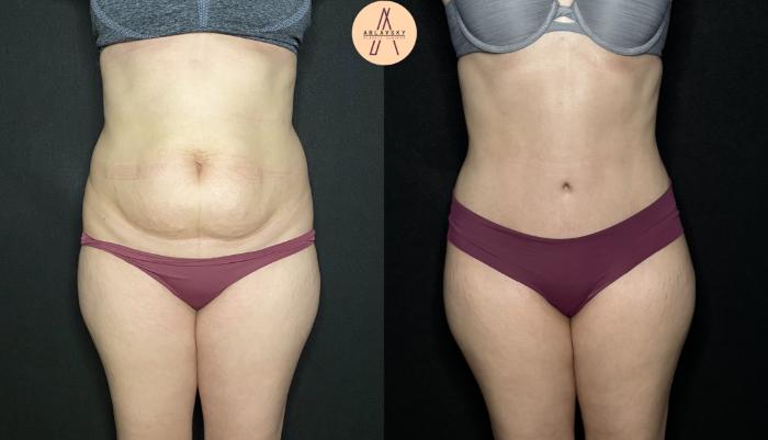 Before & After Tummy Tuck Case 197 Front View in San Antonio, Texas