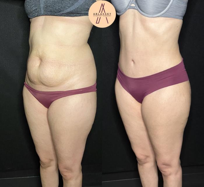 Before & After Tummy Tuck Case 197 Left Oblique View in San Antonio, Texas