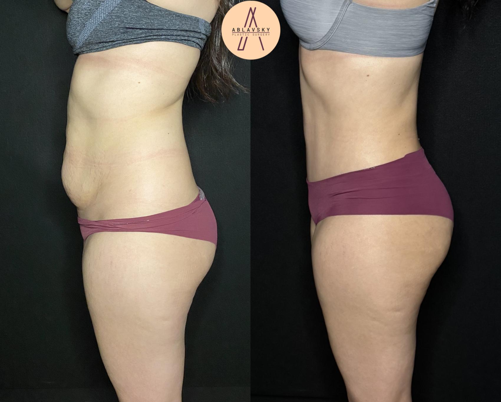 Before & After Liposuction Case 197 Left Side View in San Antonio, Texas
