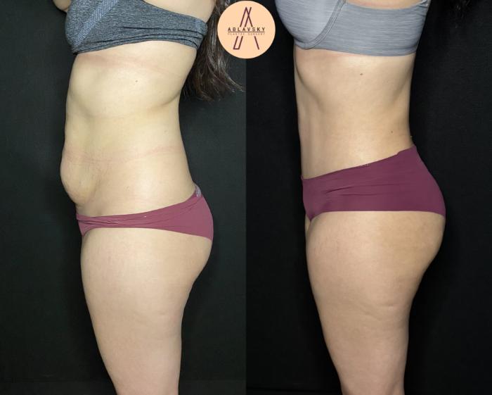 Before & After Tummy Tuck Case 197 Left Side View in San Antonio, Texas