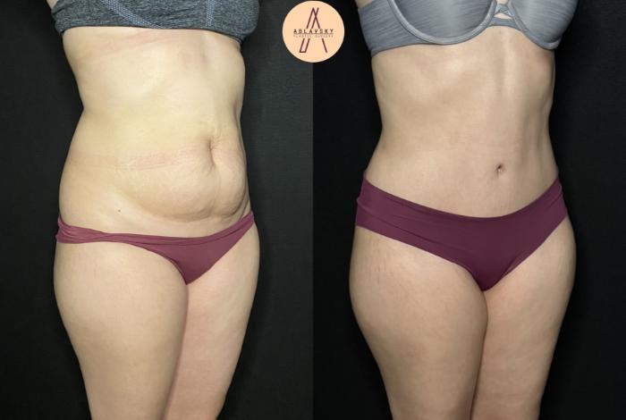 Before & After Tummy Tuck Case 197 Right Oblique View in San Antonio, Texas