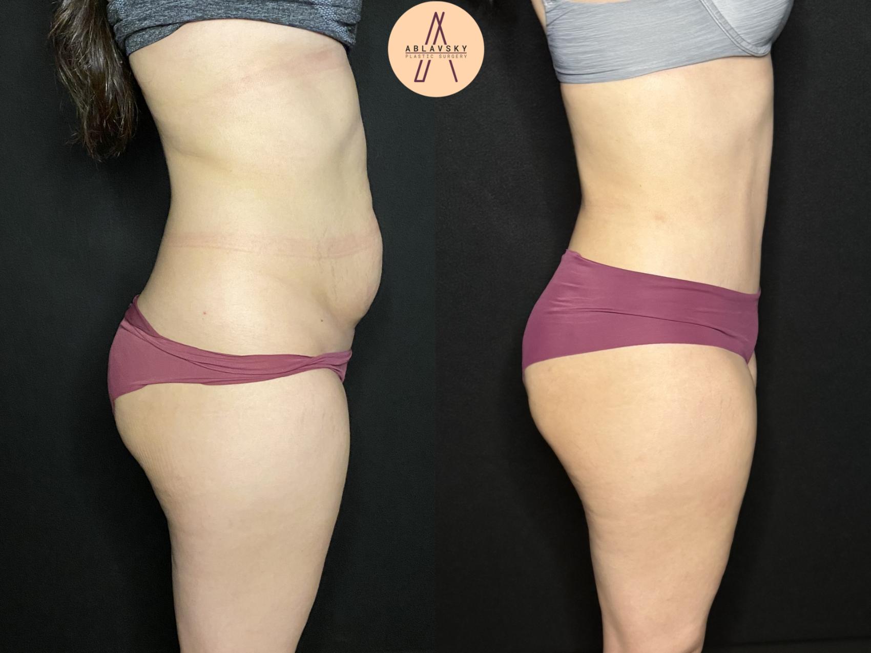 Before & After Liposuction Case 197 Right Side View in San Antonio, Texas