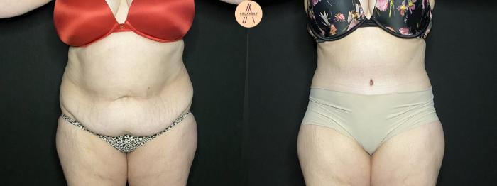 Before & After Tummy Tuck Case 201 Front View in San Antonio, Texas