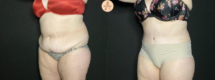 Before & After Tummy Tuck Case 201 Left Oblique View in San Antonio, Texas