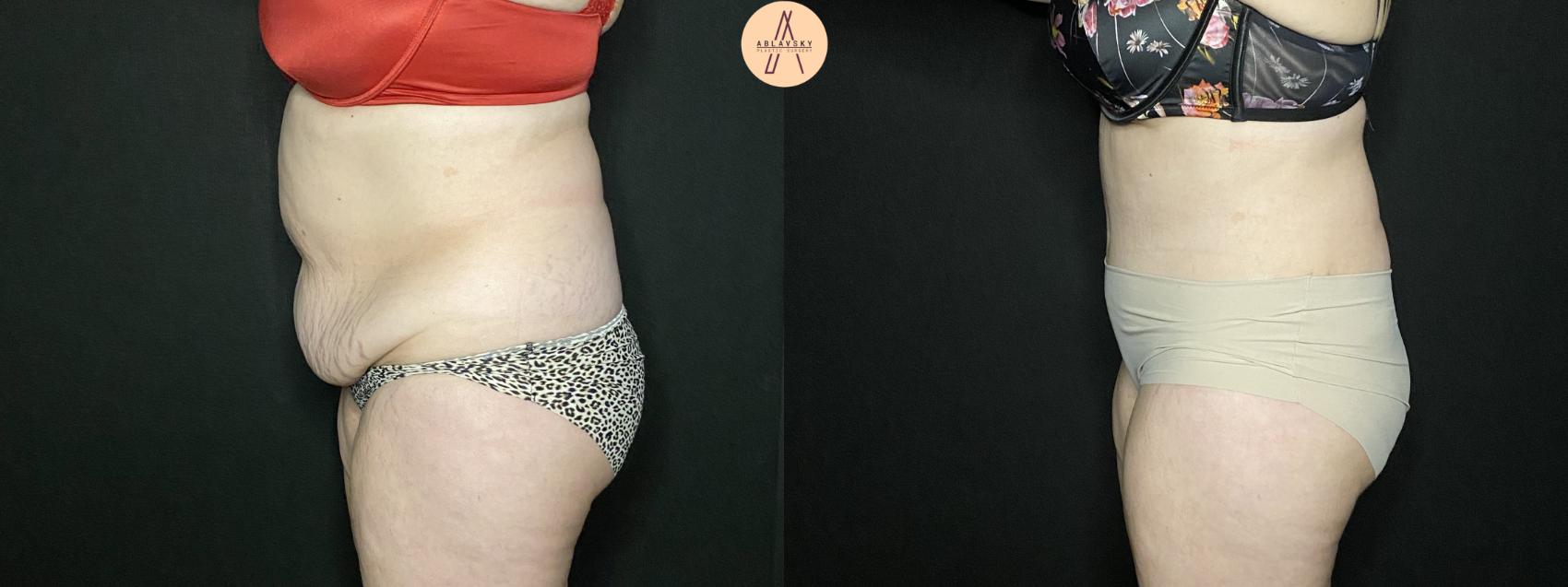 Before & After Liposuction Case 201 Left Side View in San Antonio, Texas