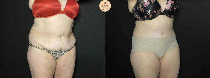 Before & After Liposuction Case 201 Right Oblique View in San Antonio, Texas
