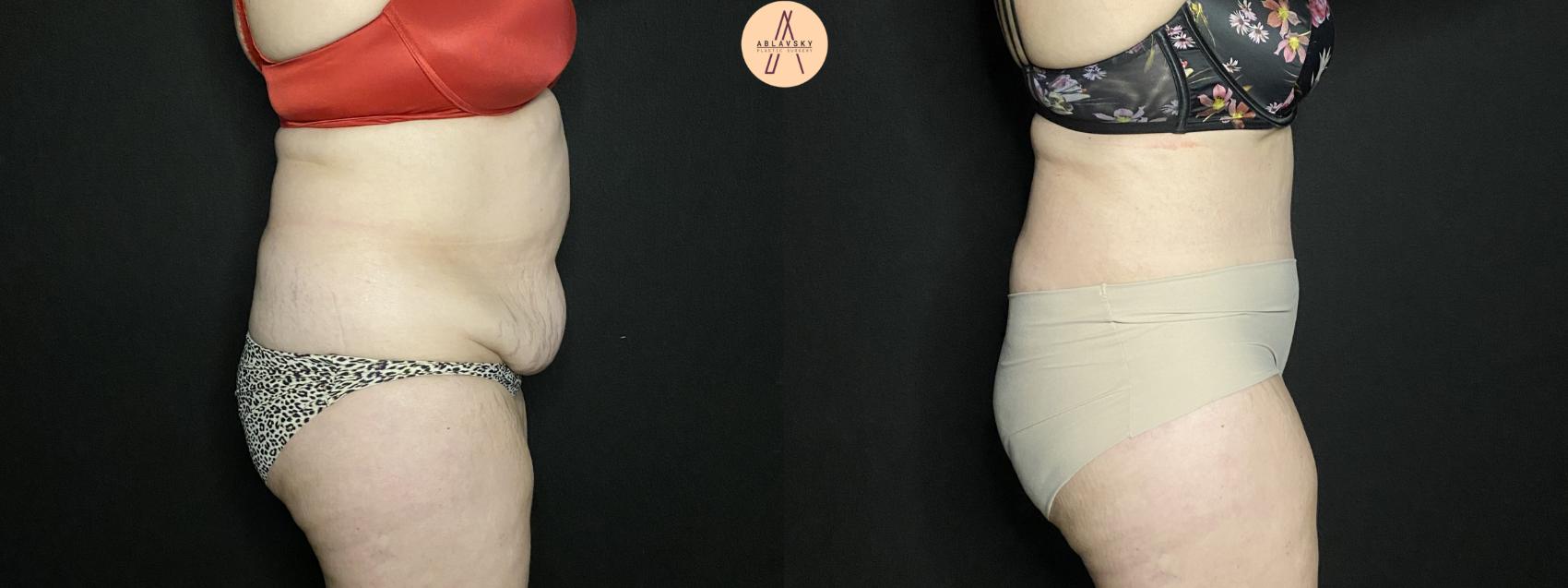 Before & After Liposuction Case 201 Right Side View in San Antonio, Texas