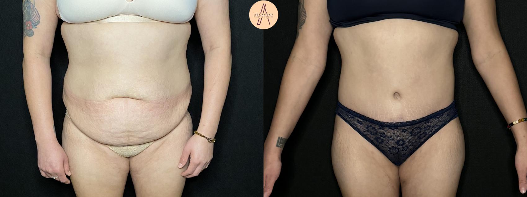 Before & After Tummy Tuck Case 206 Front View in San Antonio, Texas