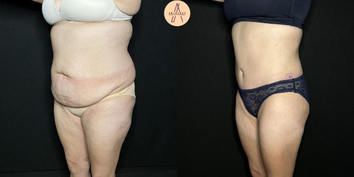 Before & After Tummy Tuck Case 206 Left Oblique View in San Antonio, Texas