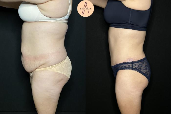 Before & After Tummy Tuck Case 206 Left Side View in San Antonio, Texas