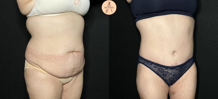 Before & After Tummy Tuck Case 206 Right Oblique View in San Antonio, Texas