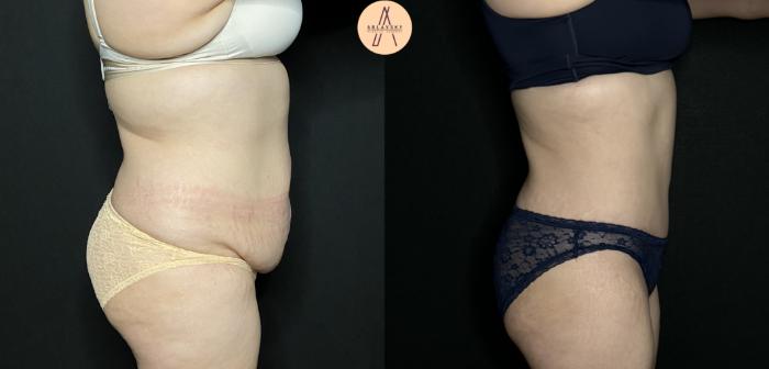 Before & After Tummy Tuck Case 206 Right Side View in San Antonio, Texas