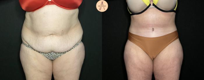 Before & After Tummy Tuck Case 219 Front View in San Antonio, Texas