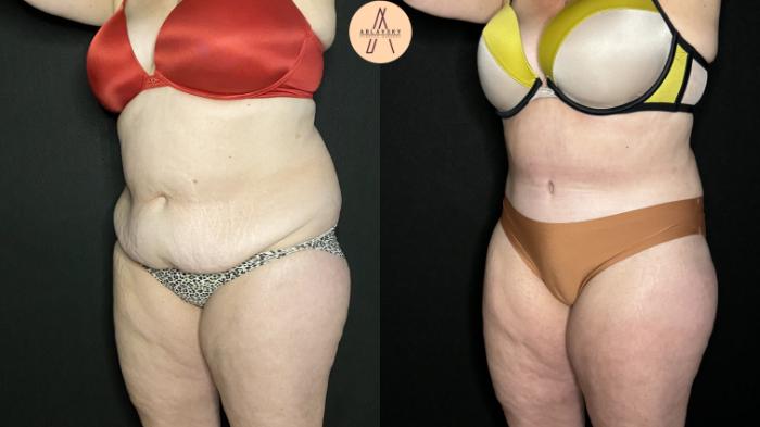 Before & After Tummy Tuck Case 219 Left Oblique View in San Antonio, Texas