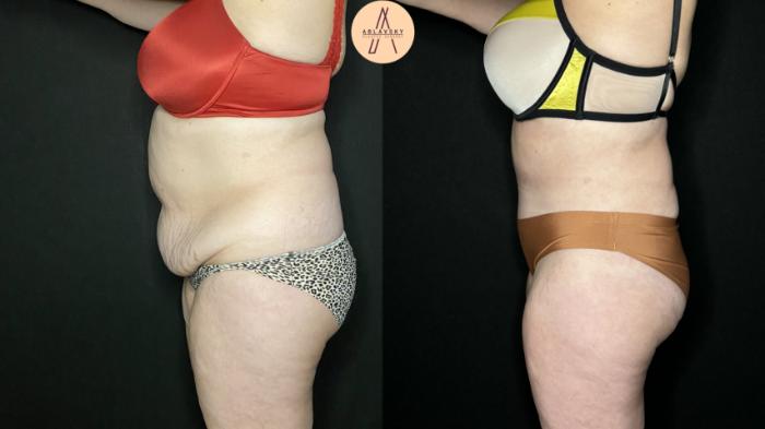 Before & After Tummy Tuck Case 219 Left Side View in San Antonio, Texas