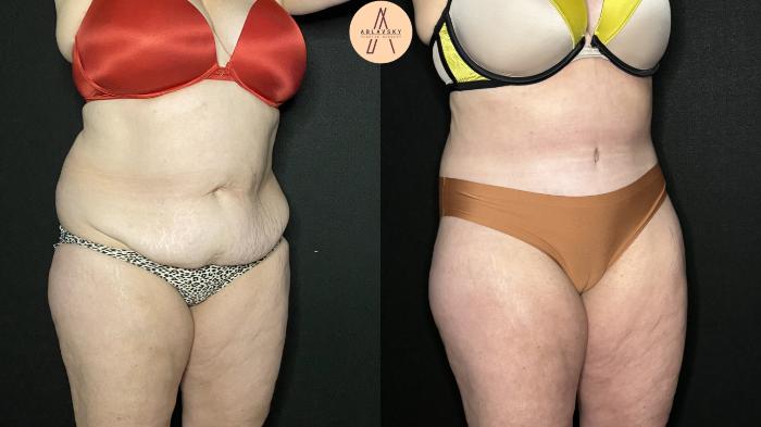 Before & After Tummy Tuck Case 219 Right Oblique View in San Antonio, Texas