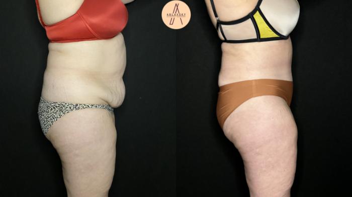 Before & After Tummy Tuck Case 219 Right Side View in San Antonio, Texas