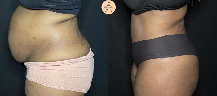 Before & After Tummy Tuck Case 231 Left Side View in San Antonio, Texas