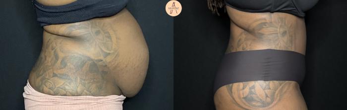 Before & After Tummy Tuck Case 231 Right Side View in San Antonio, Texas