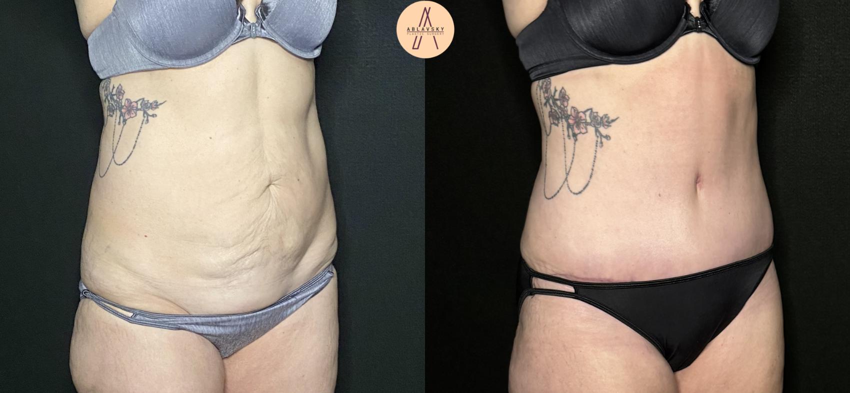 Before & After Liposuction Case 232 Left Oblique View in San Antonio, Texas