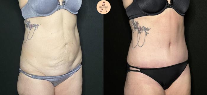 Before & After Tummy Tuck Case 232 Left Oblique View in San Antonio, Texas